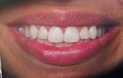 Prosthodontics and Implant Therapy Tampa photo 21